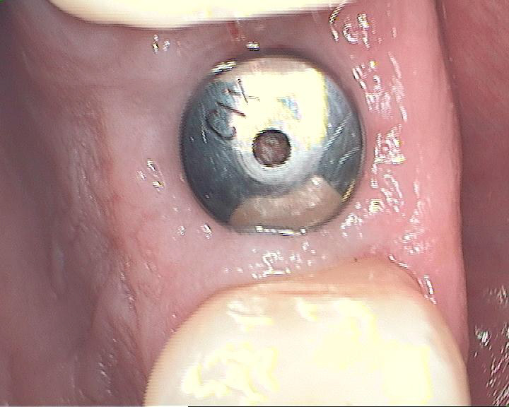 Gum Piercing Pictures