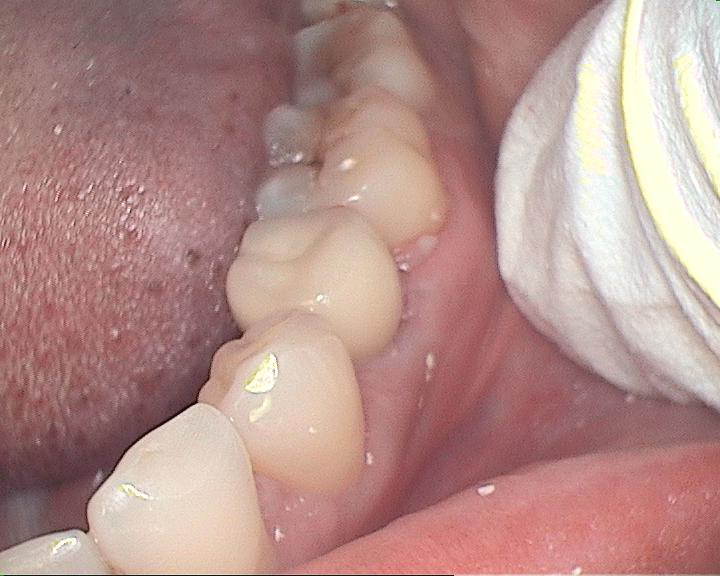 Chipped Molar Tooth Pain