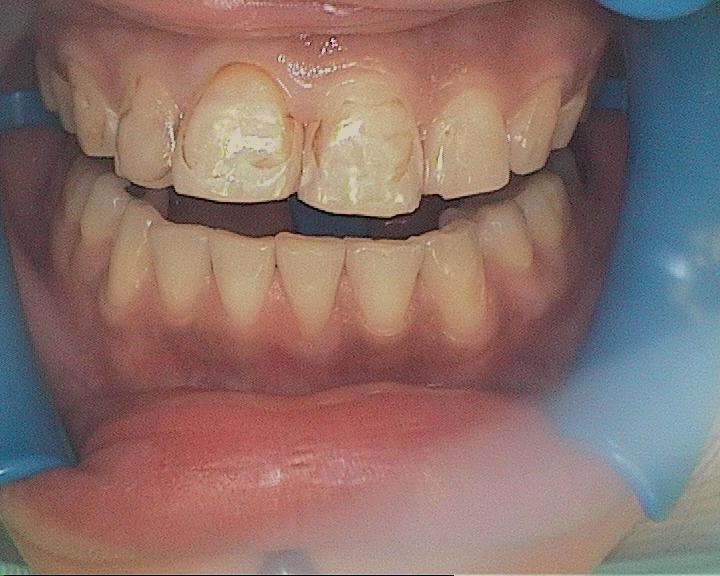 Dental Case Study Replacing Stained Composite Fillings
