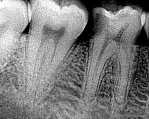 caries.46.befor