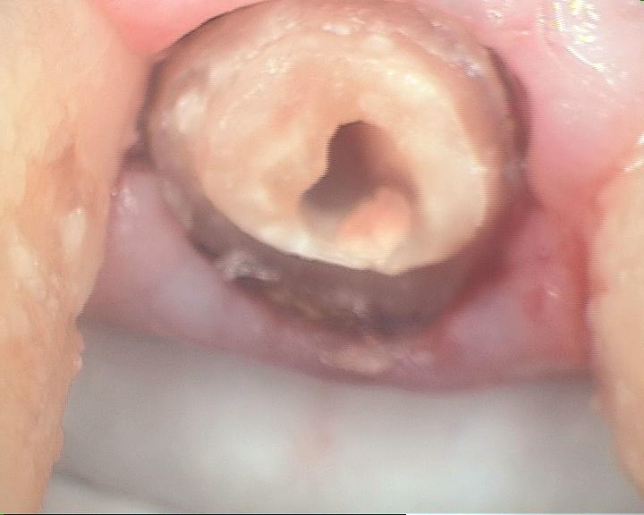 Dental Case Study Front Tooth Broken To Gum Line; Restore