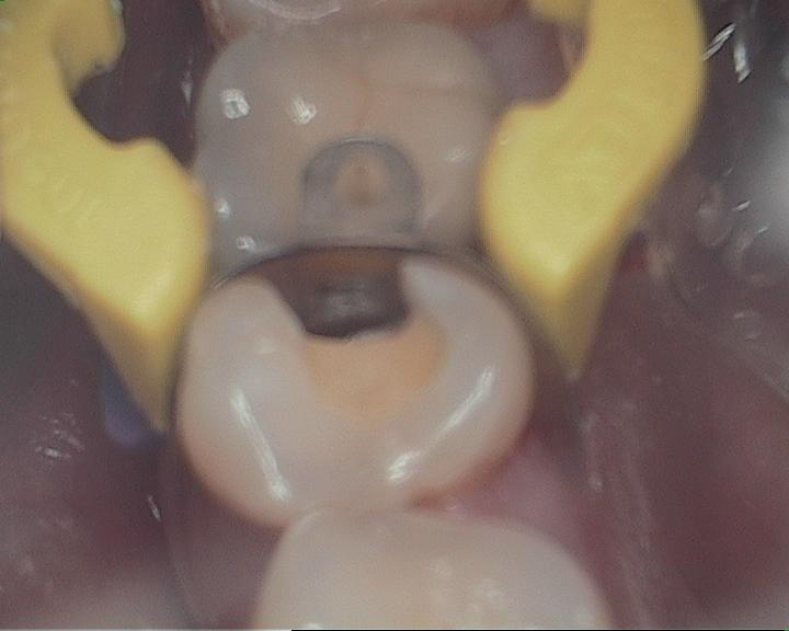 Dental Case Study Fillings to Close Food Traps