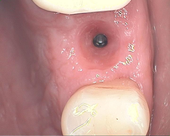 Dental Case Study Implant Healing Cap 2 Week Followup