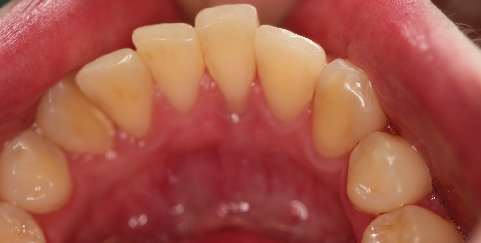 Dental Case Study Tongue Piercing Causes Recession