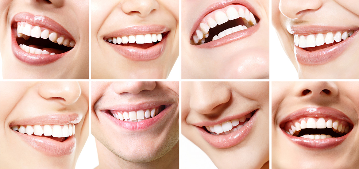 Pros-and-Cons-to-Tooth-Whitening