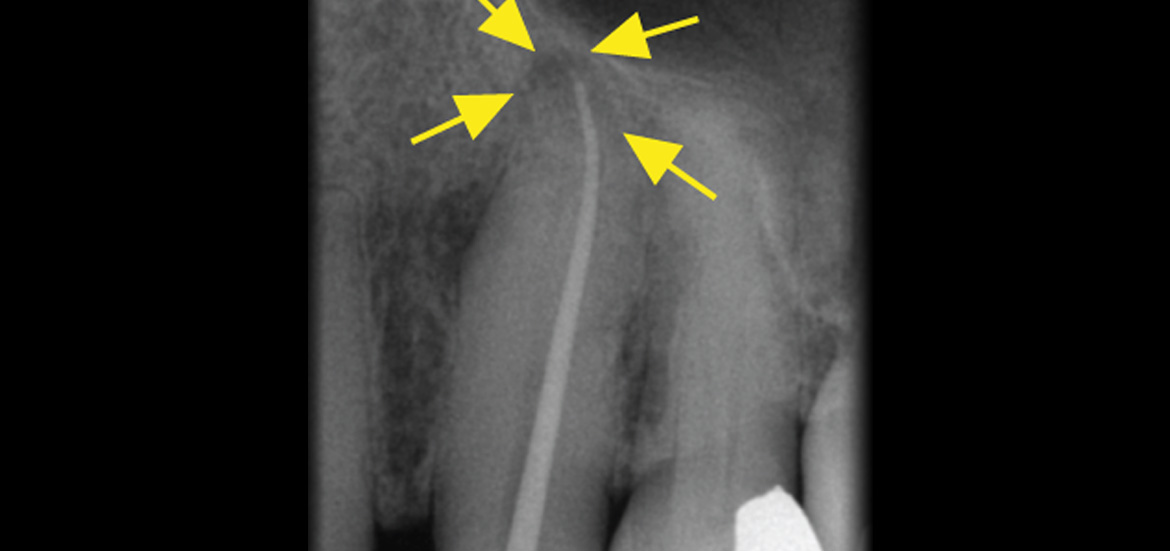 My-tooth-needs-a-root-canal-right-out-of-the-blue