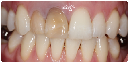 Here are how the teeth looked before we started treatment.