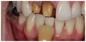 Dental Case Study: Crowning Dark Teeth After Trauma and Root Canal