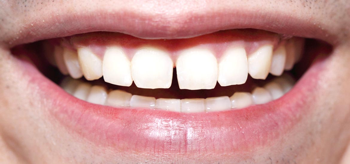 Gapped-Teeth