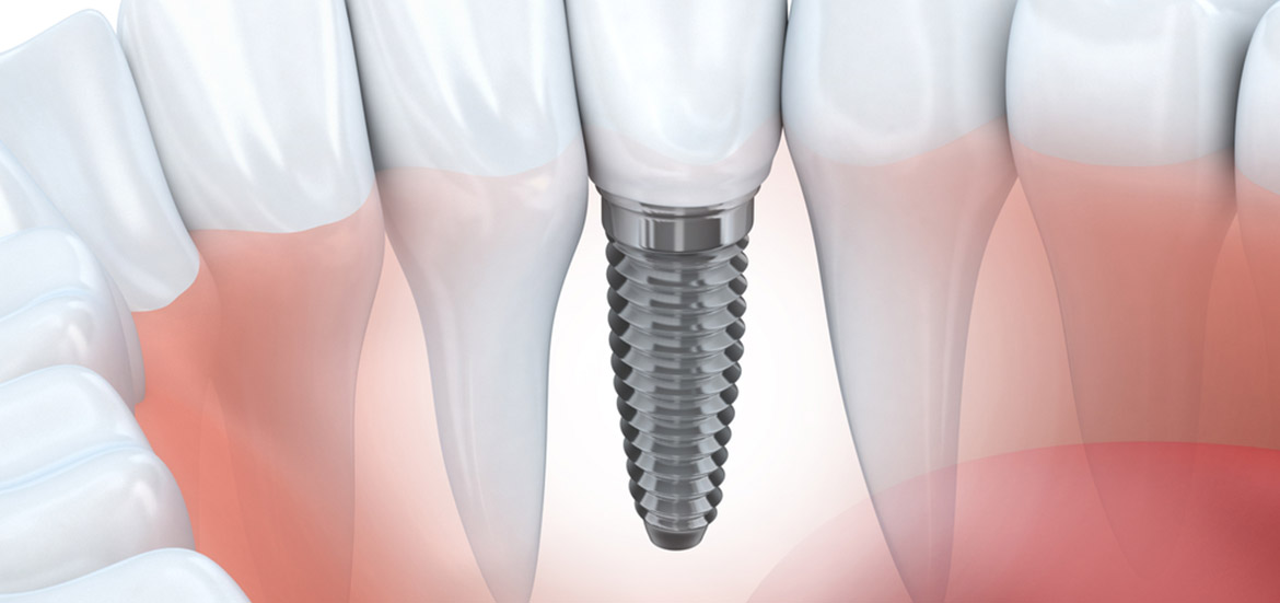 Dental-Implants